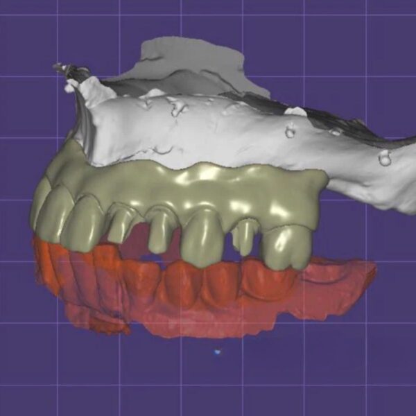 Screw Retained Implant Bridge Design on MUA