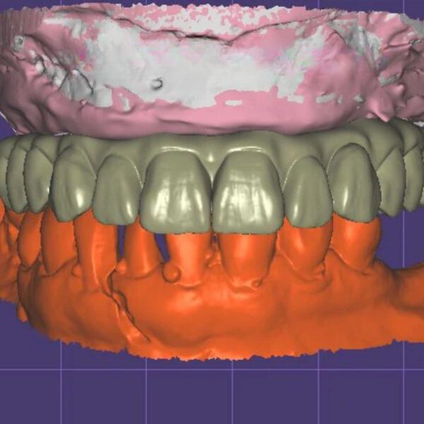 All-on-X Full Arch Implant Design Exocad