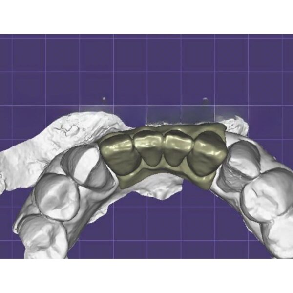 Cement Retained Zirconia Bridge on Custom Abutments