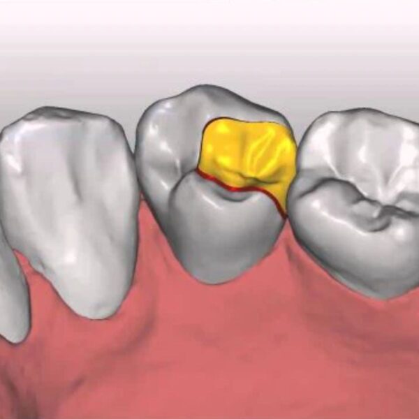 Ceramic Inlay CAD Design Exocad