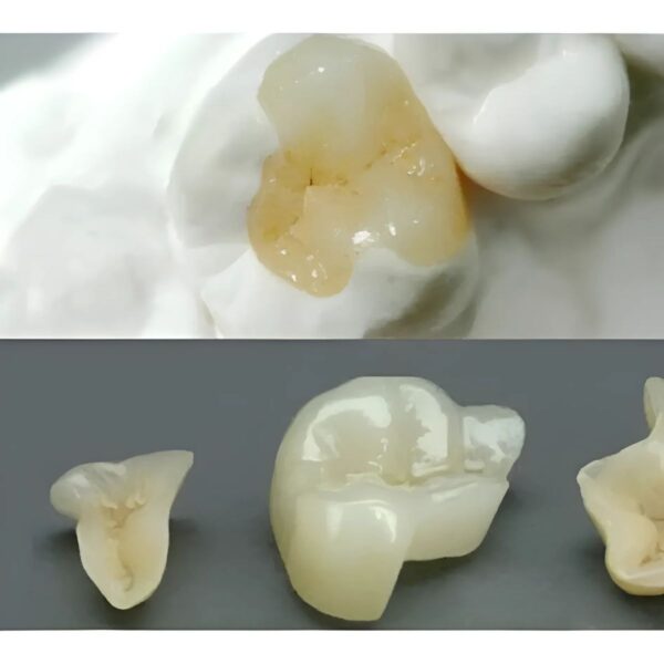 Ceramic Onlay Cusp Capping Design Exocad