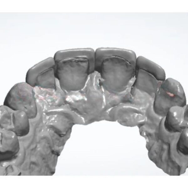 E.max Veneer CAD Design Exocad