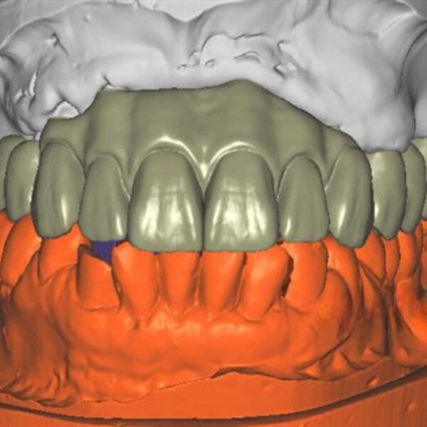 Full Anatomy Zirconia Bridge Design Exocad