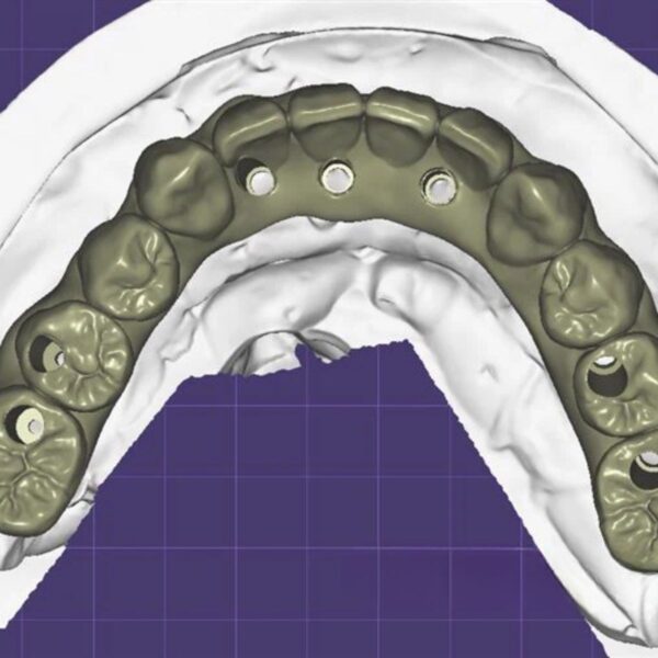 Screw Retained Zirconia Bridge on MUA Exocad