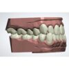 Clear Aligner Trimline Design Exocad