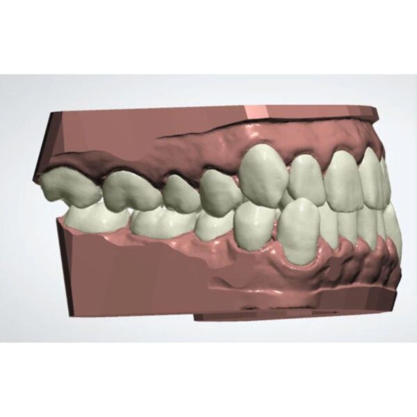 Clear Aligner Trimline Design Exocad