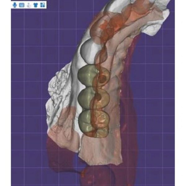 Zirconia Dental Bridge Design Exocad